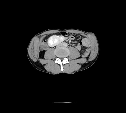 File:Bronchiectasis in Crohn disease (Radiopaedia 60311-67977 B 97).jpg