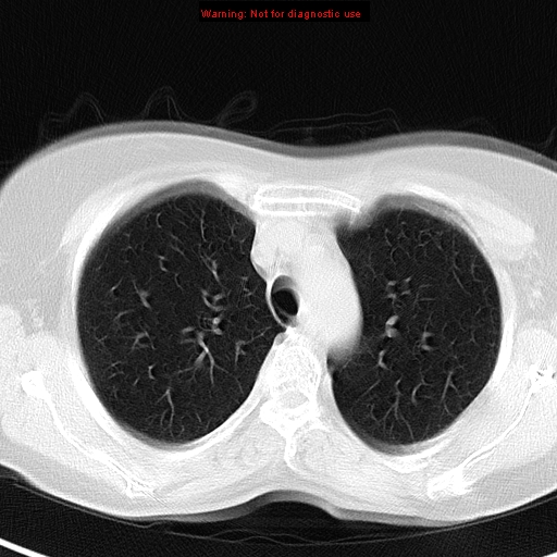 File:Bronchoalveolar carcinoma (BAC) (Radiopaedia 13436-13392 Axial lung window 13).jpg