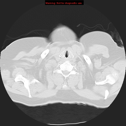 File:Bronchoalveolar carcinoma (Radiopaedia 13224-13233 Axial lung window 1).jpg