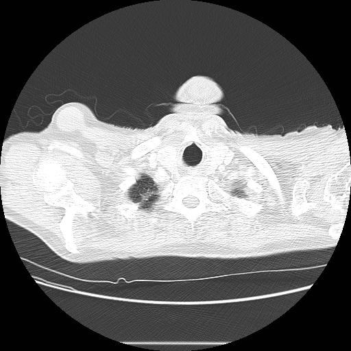 Bronchocele (Radiopaedia 17097-16795 Axial lung window 8).jpg