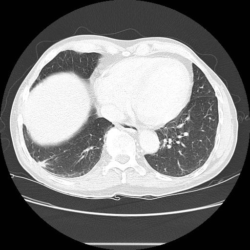 Bronchocele (Radiopaedia 17097-16795 Axial lung window 88).jpg