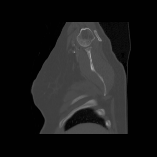 Bronchogenic carcinoma (Radiopaedia 73497-84262 Sagittal bone window 25).jpg