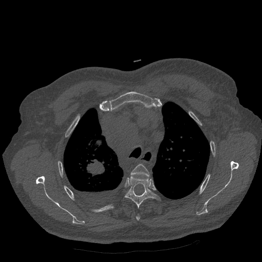Bronchogenic carcinoma with metastatic lymphadenopathy (Radiopaedia 37671-39569 Axial bone window 14).jpg