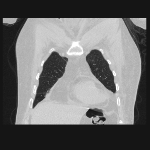 File:Bronchogenic carcinoma with metastatic lymphadenopathy (Radiopaedia 37671-39569 Coronal lung window 10).jpg