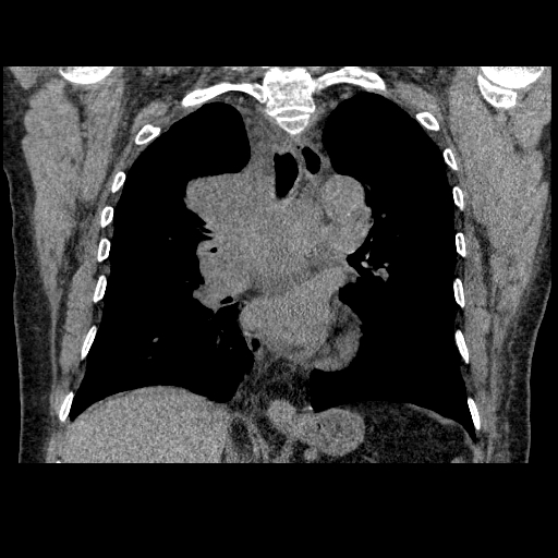 File:Bronchogenic carcinoma with metastatic lymphadenopathy (Radiopaedia 37671-39569 Coronal non-contrast 26).jpg