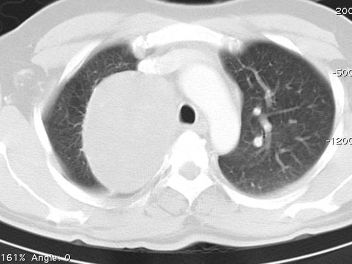 File:Bronchogenic cyst (Radiopaedia 10946-11364 Axial lung window 1).jpg