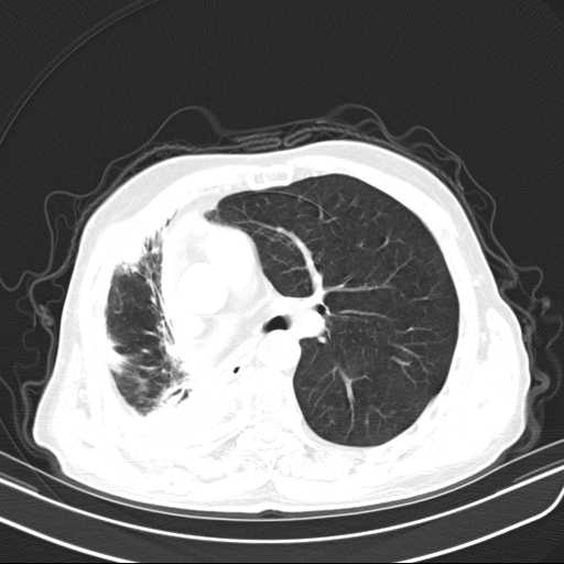 Bronchopleural fistula - postoperative complication (Radiopaedia 21020-20947 Axial lung window 25).jpg