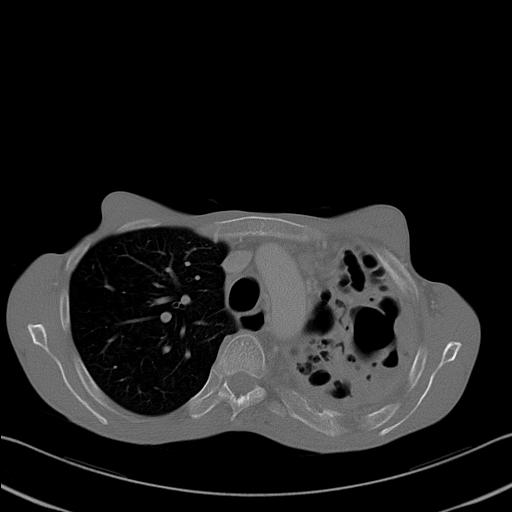 File:Bronchopleural fistula secondary to tuberculosis (Radiopaedia 20415-20322 Axial bone window 10).jpg