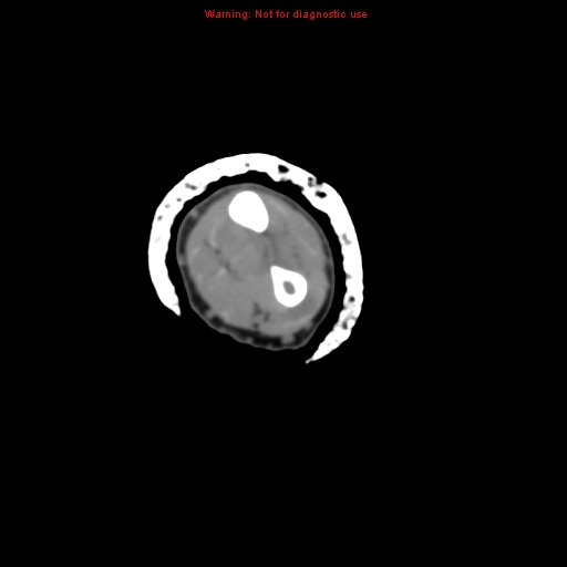 Brown tumor (Radiopaedia 12460-12694 Axial non-contrast 83).jpg