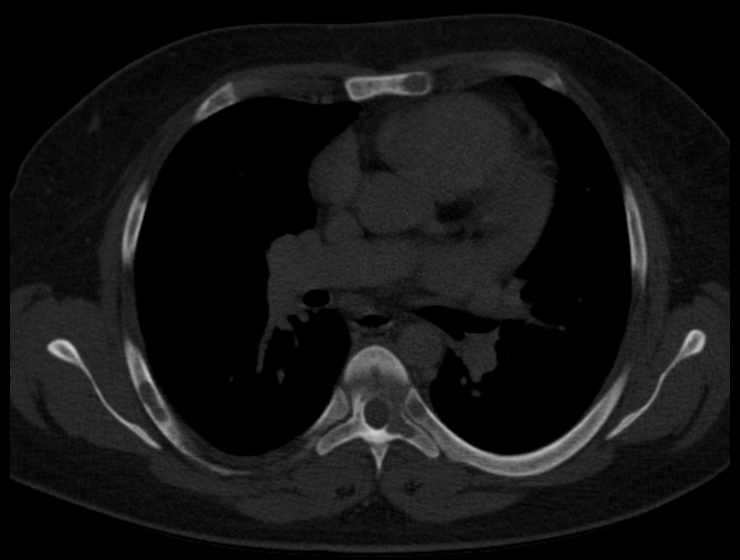 File:Brown tumors compressing the spinal cord (Radiopaedia 68442-77988 Axial bone window 35).jpg
