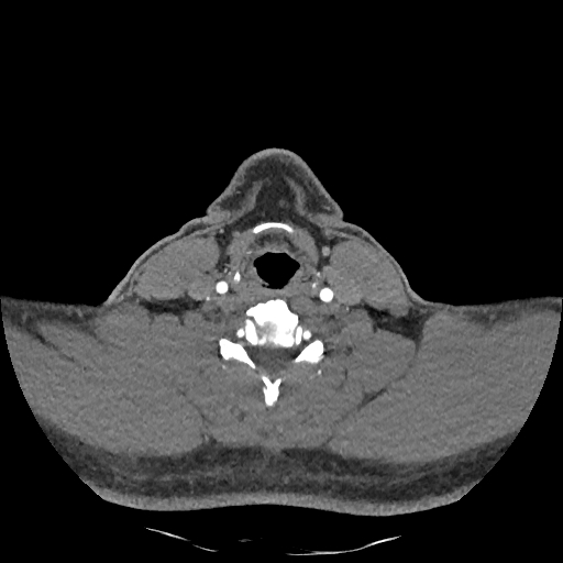 Buccal fat pad arteriovenous malformation (Radiopaedia 70936-81144 D 110).jpg