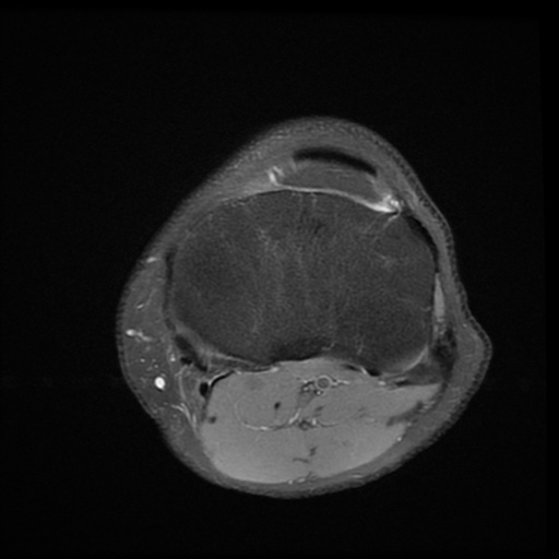 File:Bucket-handle meniscus tear (Radiopaedia 65700-74809 Axial PD fat sat 21).jpg