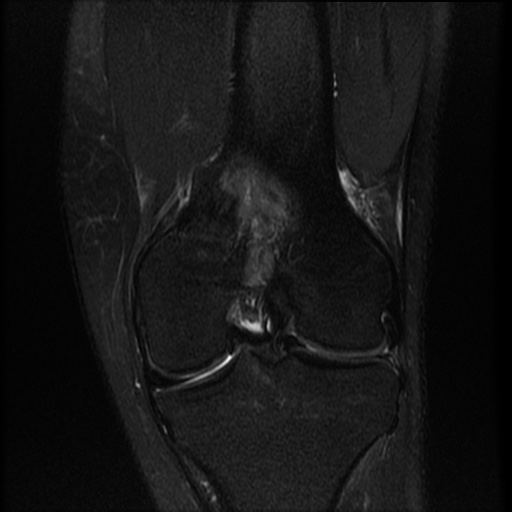 File:Bucket-handle meniscus tear (Radiopaedia 65700-74809 Coronal T2 fat sat 9).jpg