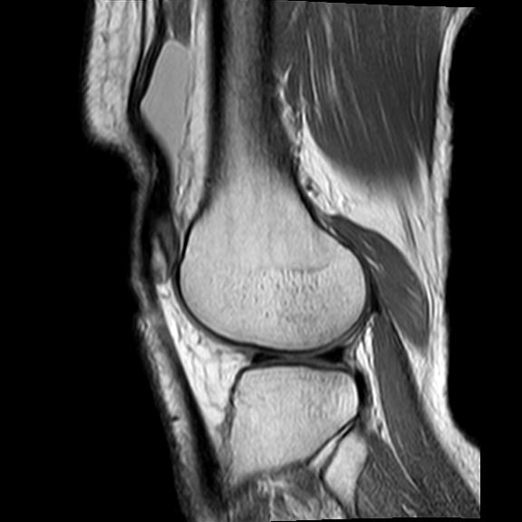 File:Bucket handle tear - medial meniscus (Radiopaedia 29250-29664 Sagittal PD 5).jpg