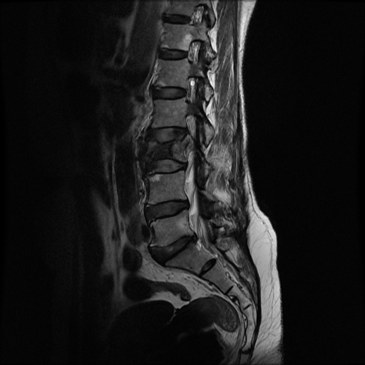 File:Burst fracture - lumbar spine (Radiopaedia 72877-83541 Sagittal T2 7).jpg
