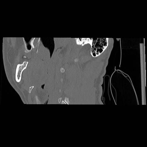 File:C1-C2 "subluxation" - normal cervical anatomy at maximum head rotation (Radiopaedia 42483-45607 C 60).jpg