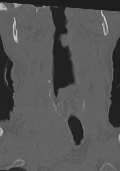 C2 fracture with vertebral artery dissection (Radiopaedia 37378-39199 Coronal bone window 2).png