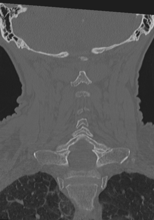 C2 fracture with vertebral artery dissection (Radiopaedia 37378-39199 Coronal bone window 34).png