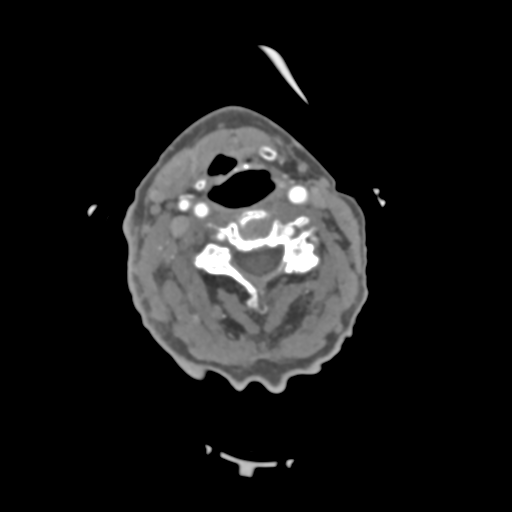 C2 fracture with vertebral artery dissection (Radiopaedia 37378-39200 A 137).png