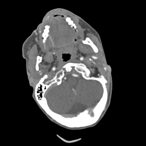 File:C2 fracture with vertebral artery dissection (Radiopaedia 37378-39200 A 187).png