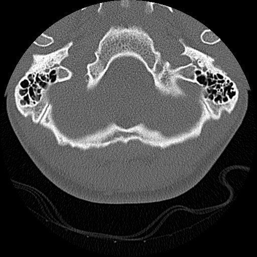 File:C5 facet fracture (Radiopaedia 58374-65499 Axial bone window 3).jpg