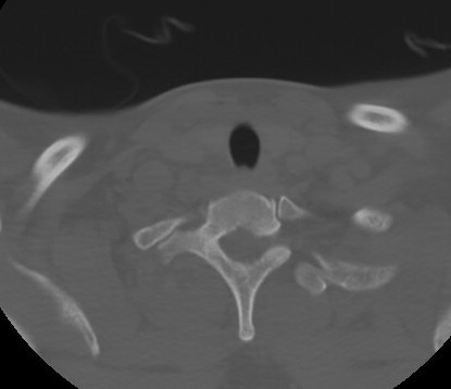 C7 laminar fracture and Klippel-Feil syndrome (Radiopaedia 86710-102850 Axial bone window 65).jpg