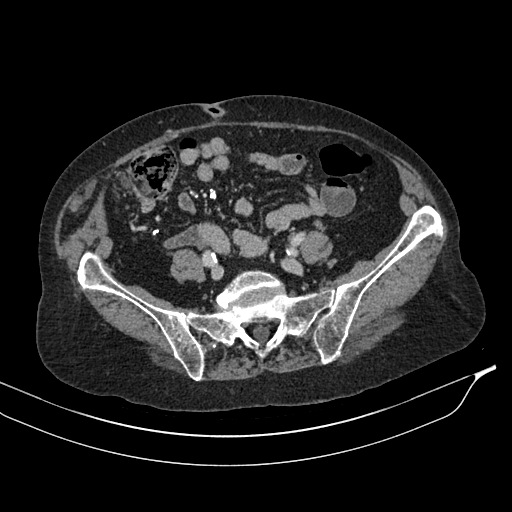 Calcified adrenal glands and Spigelian hernia (Radiopaedia 49741-54988 A 162).jpg