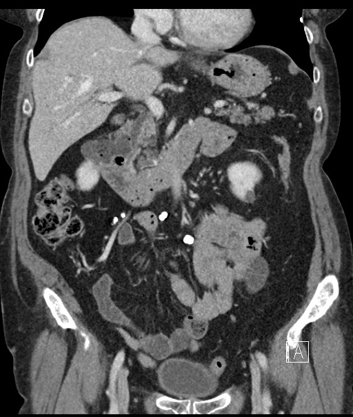 Calcified adrenal glands and Spigelian hernia (Radiopaedia 49741-54988 B 48).jpg