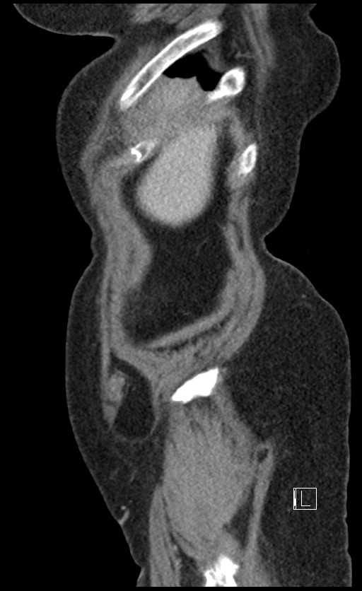 Calcified adrenal glands and Spigelian hernia (Radiopaedia 49741-54988 C 147).jpg