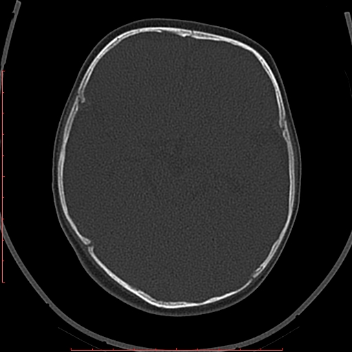 Calcified middle cerebral artery embolism (Radiopaedia 78949-91860 Axial bone window 22).jpg