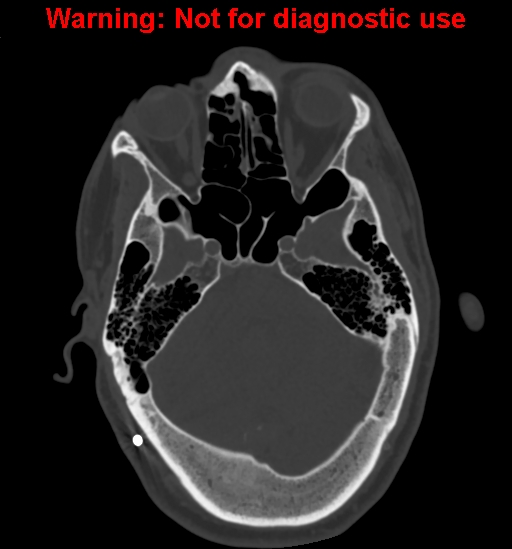 Calvarial thickening from chronic shunting (Radiopaedia 60079-67637 Axial bone window 53).jpg