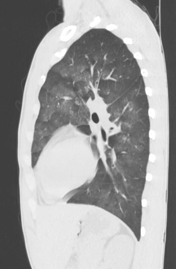 Cannabis-induced diffuse alveolar hemorrhage (Radiopaedia 89834-106946 Sagittal lung window 94).jpg