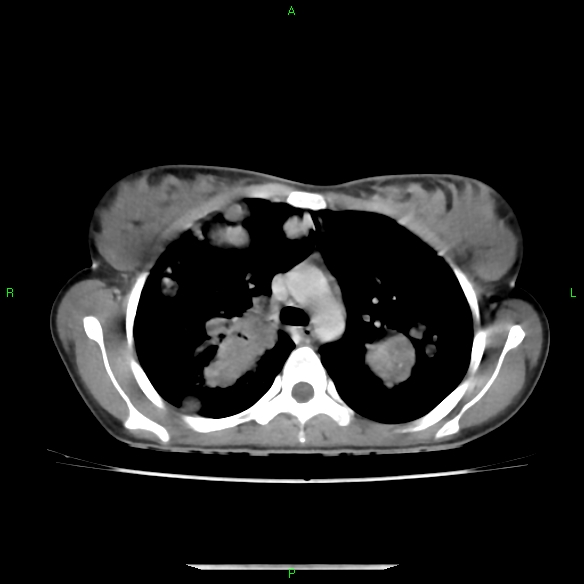 File:Cannon ball metastases - synovial sarcoma (Radiopaedia 26135-26271 C 13).jpg