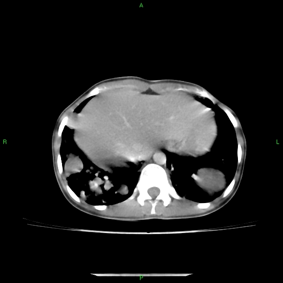 File:Cannon ball metastases - synovial sarcoma (Radiopaedia 26135-26271 C 31).jpg
