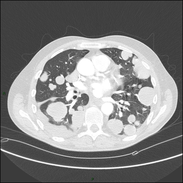 Cannonball metastases (Radiopaedia 82110-96150 Axial lung window 106).jpg