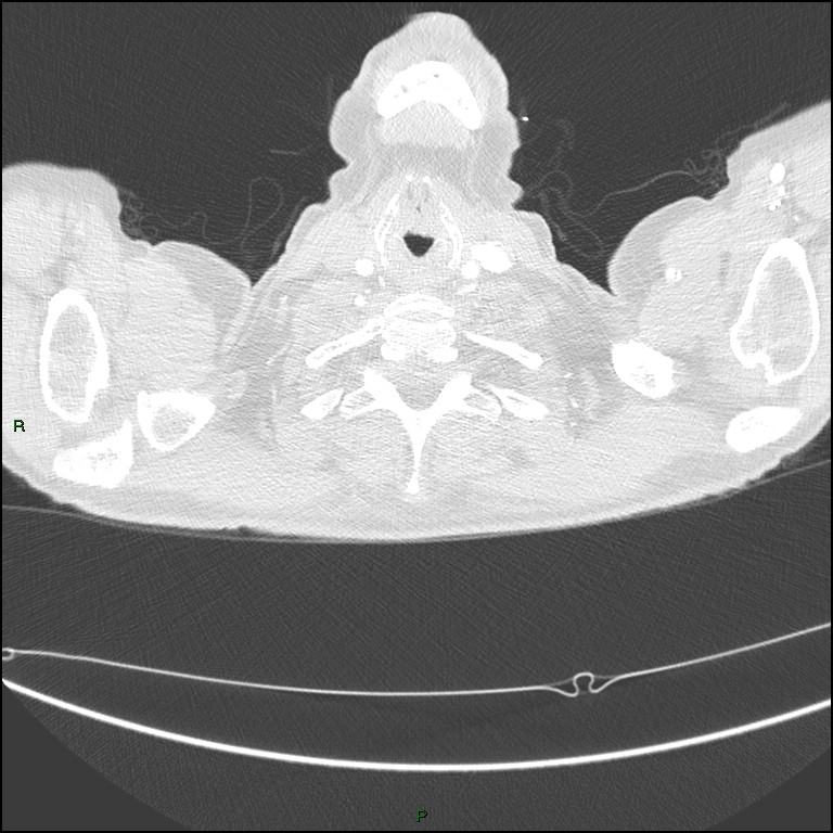 Cannonball metastases (Radiopaedia 82110-96150 Axial lung window 11).jpg