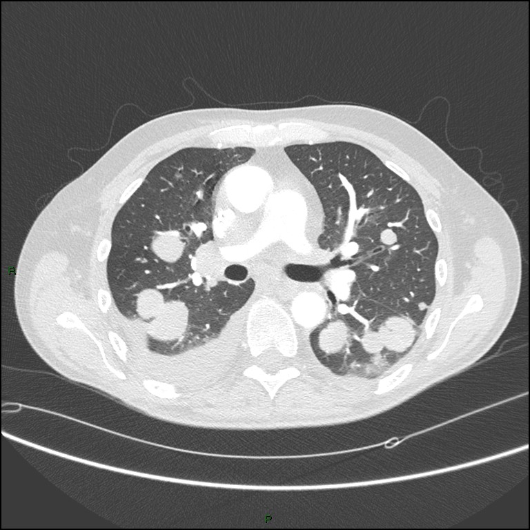 Cannonball metastases (Radiopaedia 82110-96150 Axial lung window 90).jpg