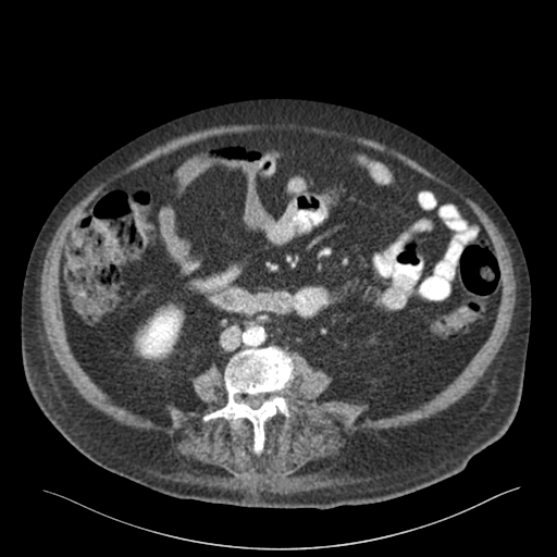 Cannonball metastases from endometrial cancer (Radiopaedia 42003-45031 F 1).png
