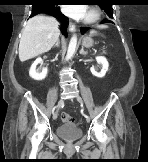 File:Cannonball metastases from endometrial cancer (Radiopaedia 42003-45031 F 40).png
