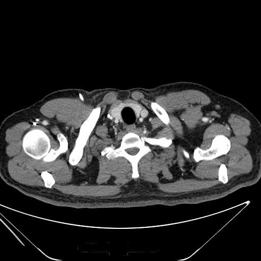 File:Cannonball pulmonary metastases (Radiopaedia 67684-77101 D 10).jpg