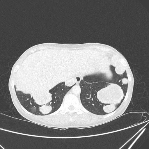 File:Canonball lung metastasis (Radiopaedia 77634-89837 Axial lung window 152).jpg