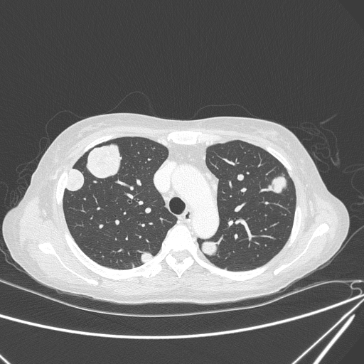 Canonball lung metastasis (Radiopaedia 77634-89837 Axial lung window 56).jpg