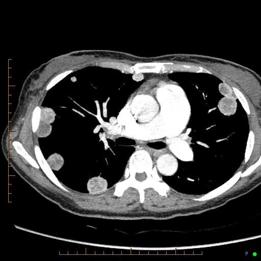 Canonball lung metastasis (Radiopaedia 77634-89837 B 41).jpg