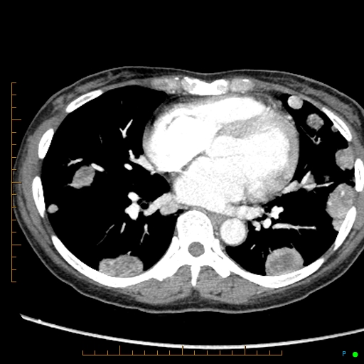 Canonball lung metastasis (Radiopaedia 77634-89837 B 58).jpg
