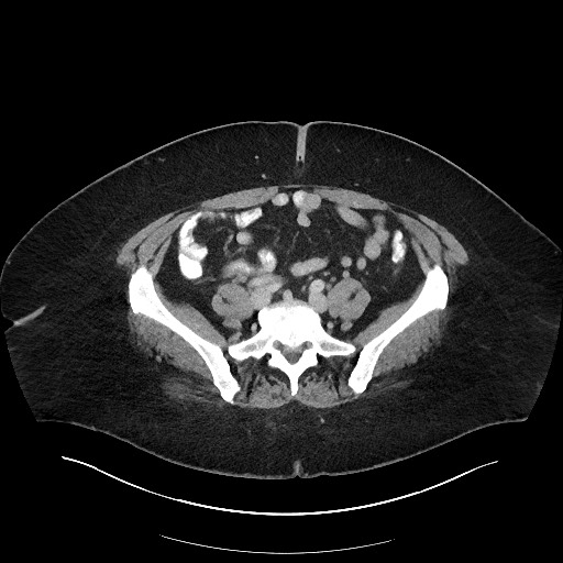 Carcinoid tumor - terminal ileum (Radiopaedia 60931-68739 A 92).jpg