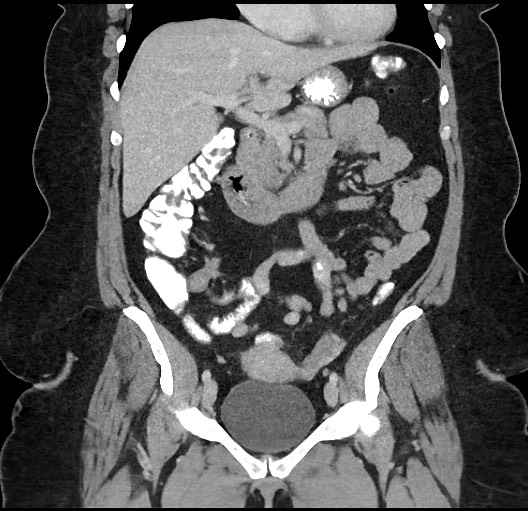 Carcinoid tumor - terminal ileum (Radiopaedia 60931-68739 B 34).jpg