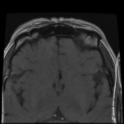File:Carcinoid tumor of the ileum with metastasis to orbit (Radiopaedia 28165-28424 Axial T1 9).jpg