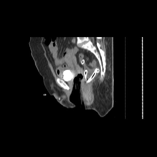File:Carcinoma cervix- brachytherapy applicator (Radiopaedia 33135-34173 D 98).jpg