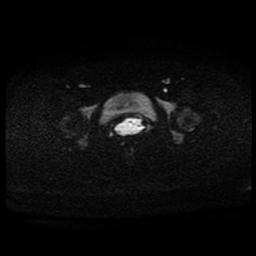 Carcinoma of the cervix (Radiopaedia 89018-105858 Axial DWI 50).jpg