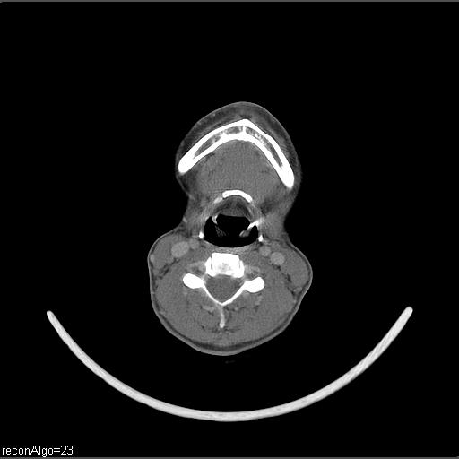 Carcinoma of the maxillary antrum (Radiopaedia 53805-59888 Axial C+ delayed 25).jpg